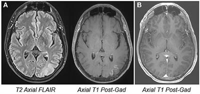 Case Report: Prolonged Effects of Short-Term Transcranial Magnetic Stimulation on EEG Biomarkers, Spectral Power, and Seizure Frequency